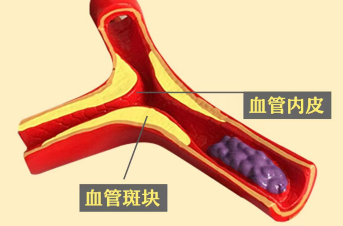 血管斑块.png